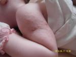Аллергический дерматит на теле у ребенка фото 2