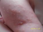 Аллергический дерматит на теле у ребенка фото 3