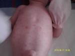 Аллергический дерматит на теле у ребенка фото 1