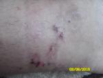 Что это за кожное заболевание, лечение? фото 2