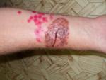 Вокруг раны образовалась язва и на коже сыпь фото 1