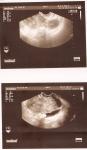 Расшифровка УЗИ на 13 день менструального цикла фото 1
