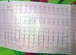 Учащенное сердцебиение, расшифровка ЭКГ фото 3