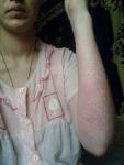Болит кожа на руке после термического ожога! ПРОШЛО 1 ГОД 8 МЕС фото 4