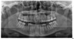 Лечение зуба фото 1