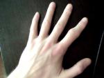 Нарост на пальце после перелома фото 1