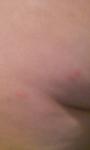 Появилась сыпь по телу похожа на укусы комара фото 2