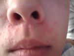 Сыпь на лице в течение 4 месяцев фото 2