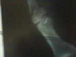 Рентген перелома фаланги пальца фото 1