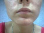Высыпания на коже лица, алергия, акне фото 2