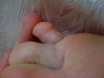 Подкожная шишка на пальце ноги фото 5
