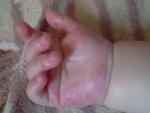 Сыпь на ладонях грудного ребенка фото 1