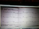 Расшифровка кардиограммы, ощущение перехватывания дыхания  фото 1