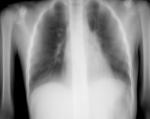 Рентгеновская томография легких фото 1