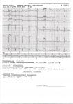 Расшифровка ЭКГ (частые головокружения) фото 1