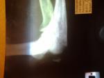Краевой перелом локтевого отростка со смещением фото 1