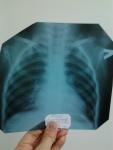 Пневмония на рентгене консультация фото 1