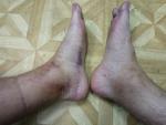 Отек и цианоз ног фото 1