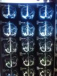 МРТ: Отсутствие визуализации кровотока по левой ярёмной вене фото 2