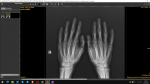 Есть ли патологии на рентгене кистей рук? фото 4
