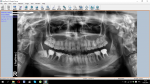 Удаление зуба мудрости, опухоль под языком фото 2