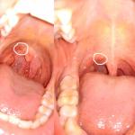 Шишечка около язычка на слизистой полости рта фото 1