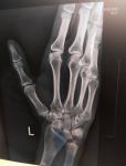 Рентген пальца фото 1