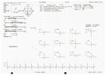 Результаты ЭКГ, жалобы на боль в груди фото 1