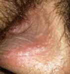 Сыпь на гениталиях без ощущения зуда или жжения фото 2