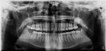 Проблема после пломбировки двух каналов на 24-м зубе вверху челюсти фото 1