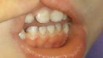 Налет на зубах у ребенка фото 1