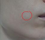 Белые пятна на коже вокруг рта фото 1