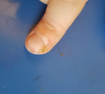 Болячка около ногтя на пальце руки фото 5