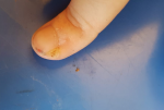 Болячка около ногтя на пальце руки фото 1