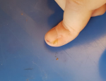 Болячка около ногтя на пальце руки фото 4