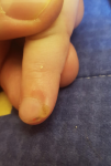 Болячка около ногтя на пальце руки фото 3