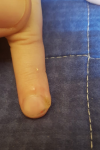 Болячка около ногтя на пальце руки фото 2