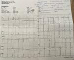 Увеличение нагрузки, снижение ST в стенке миокарда лж фото 1