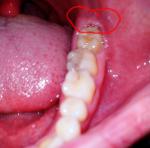 Воспаление десны у зуба мудрости (давно выросшего) фото 1