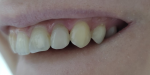 Промежуток между 2и3 зубом после лечения фото 1