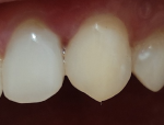 Промежуток между 2и3 зубом после лечения фото 2