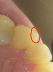 Промежуток между 2и3 зубом после лечения фото 3