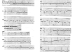 Боль в сердце, ЭКГ фото 1