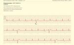 Провалы на ЭКГ в 1 отведении фото 1