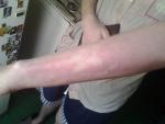 Болит кожа на руке после термического ожога! ПРОШЛО 1 ГОД 8 МЕС фото 3