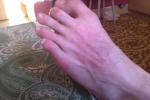 Раздражение кожи на ногах, красные пятна фото 1