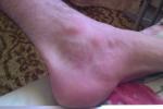 Раздражение кожи на ногах, красные пятна фото 2