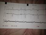 Расшифровка ЭКГ сердца онлайн фото 3