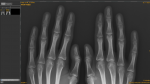 Есть ли патологии на рентгене кистей рук? фото 3