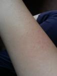 Красные пятна выше локтя фото 1